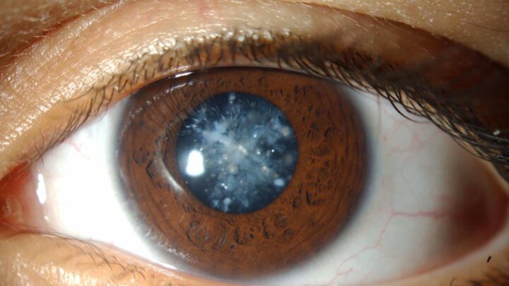 В чем плюсы своевременного лечения катаракты