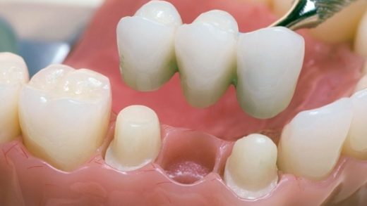 Чем привлекательны мостовидные зубные протезы