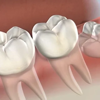 Все, що потрібно знати перед видаленням зуба мудрості